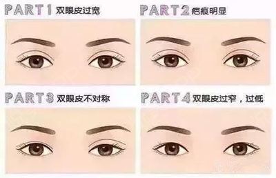 双眼皮做修复