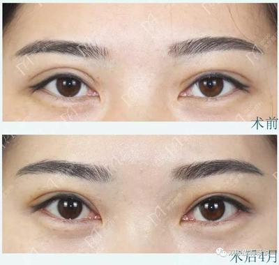 双眼皮如何抽脂