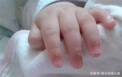 宝宝手倒刺缺什么营养
