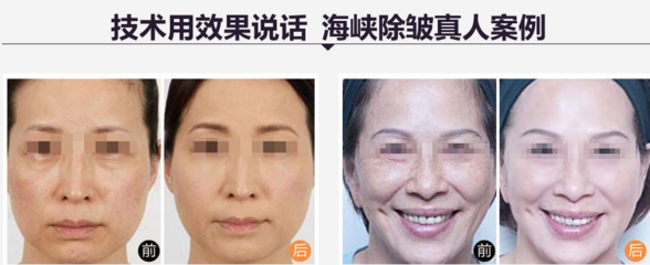 济南除皱针多少钱