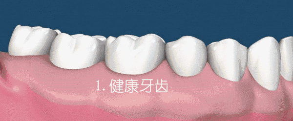 牙齿磨损牙龈流血