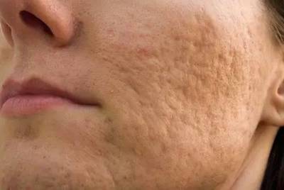 脸上好多痘印痘痘可以用维e吗