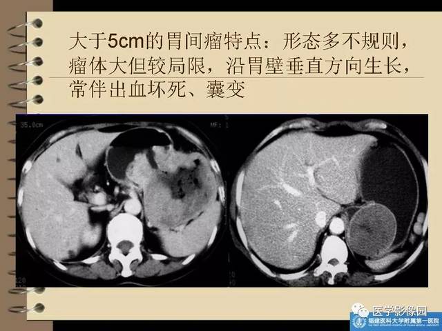 间质瘤是怎么回事