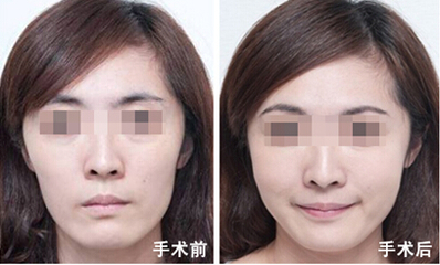 玻尿酸丰苹果肌效果