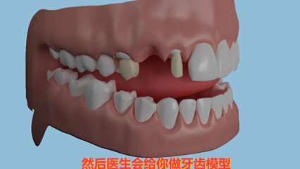 蛀牙拔了一定要种牙吗