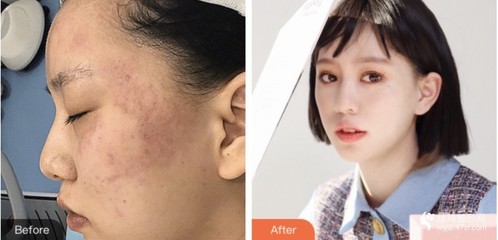 激光收缩毛孔可以维持多久