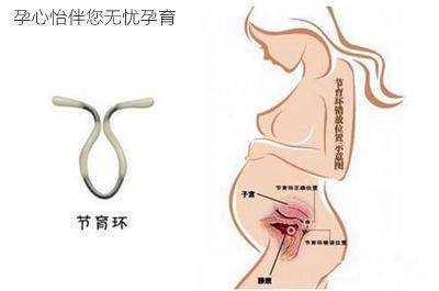 上环久了会影响怀孕吗