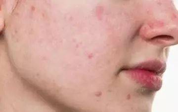 脸上长痘痘能挤出来