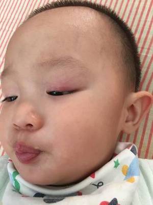 婴儿眼皮肿是怎么回事