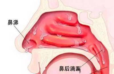 鼻后滴漏咳嗽特点