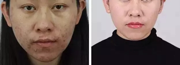 痘痘怎么消除当先云南美莱
