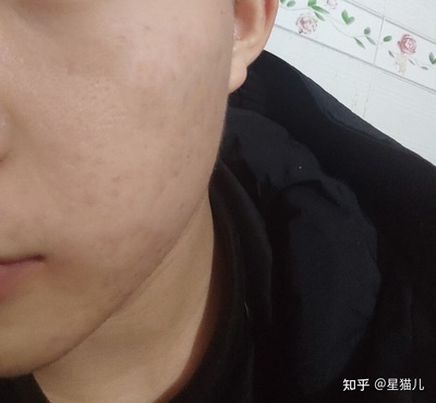 男生脸的两侧长痘痘的原因