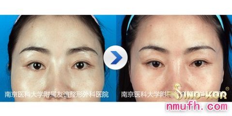 双眼皮割完一年不消肿