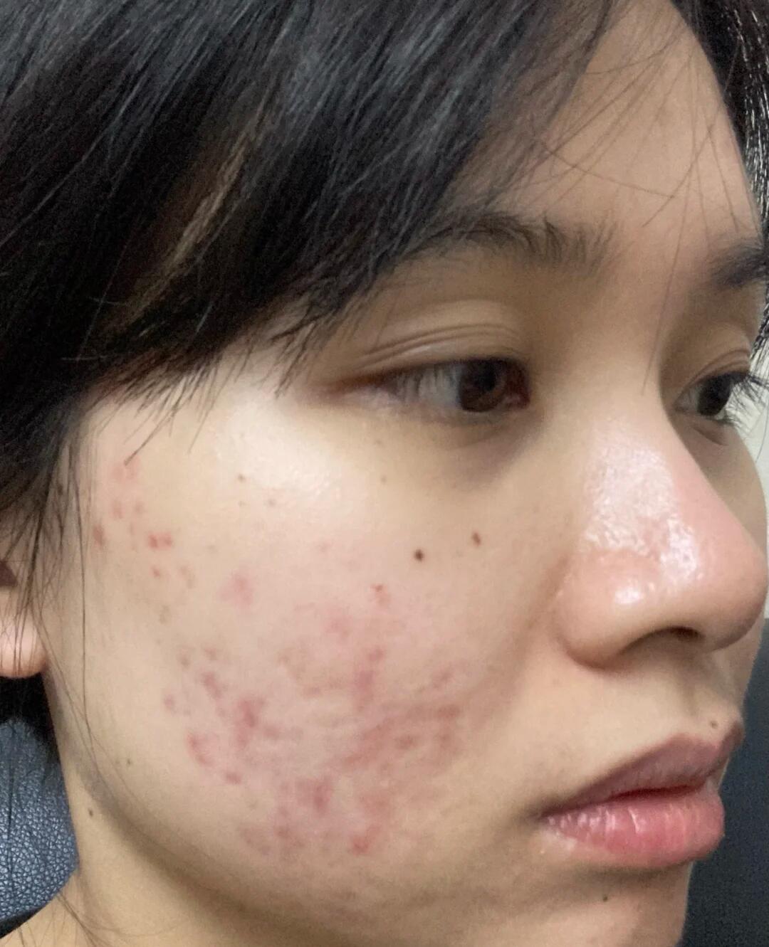 满脸痘印