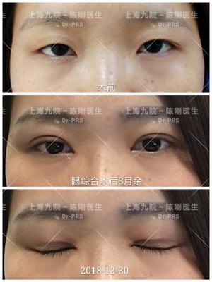 双眼皮疤痕多久才淡化