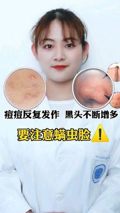 长痘痘的时候可以蒸脸吗