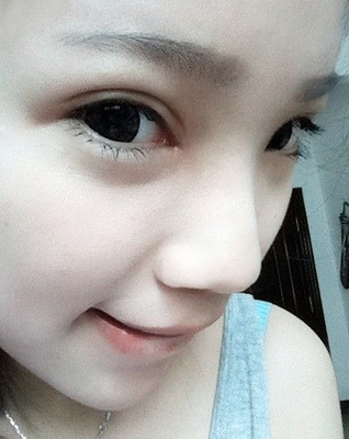 开眼角拆线后多久化妆