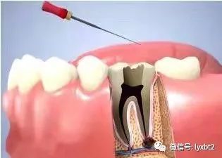 拔牙后多久恢复正常