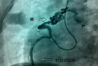 冠状动脉瘘怎么治疗
