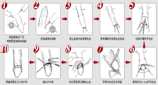 手动包皮粘连分离清洗多少钱