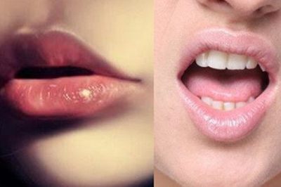 嘴唇一夜起泡是什么原因,如何快速消除嘴唇起泡?