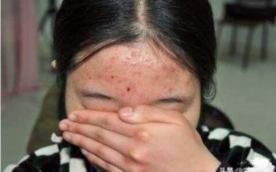 男的恋爱后长痘痘