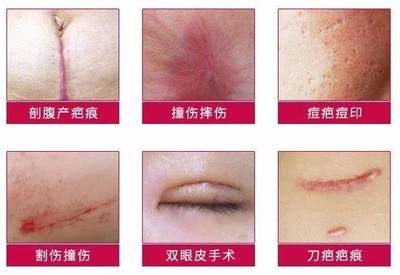 双眼皮刀疤多久能恢复
