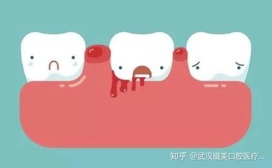 洗牙多久