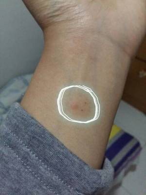 针灸治痘痘扎那个部位