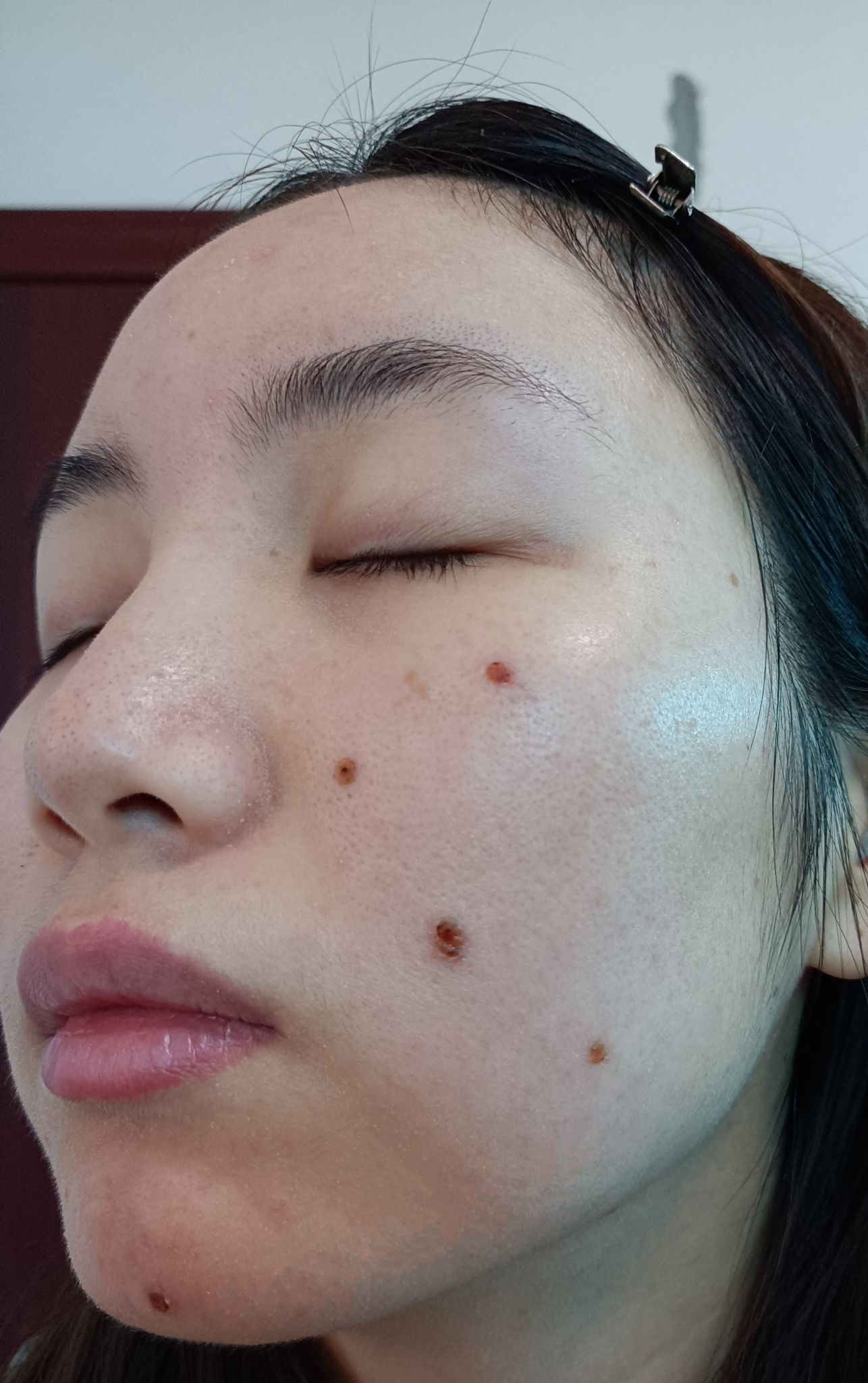 熬夜脸上起好多痘痘怎么办