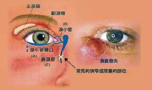 泪囊堵塞怎么治疗