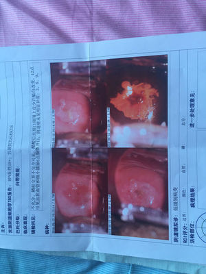 治宫颈糜烂手术价格多少费用