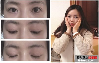 三点双眼皮多久能化妆
