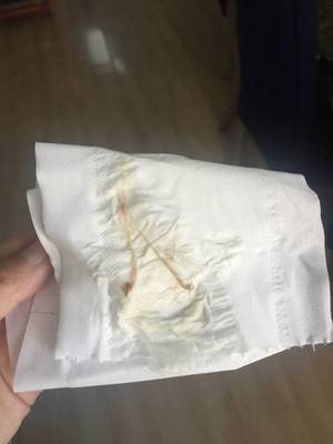 怀孕了白带会变多吗