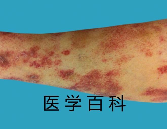 脚上有血斑是怎么回事
