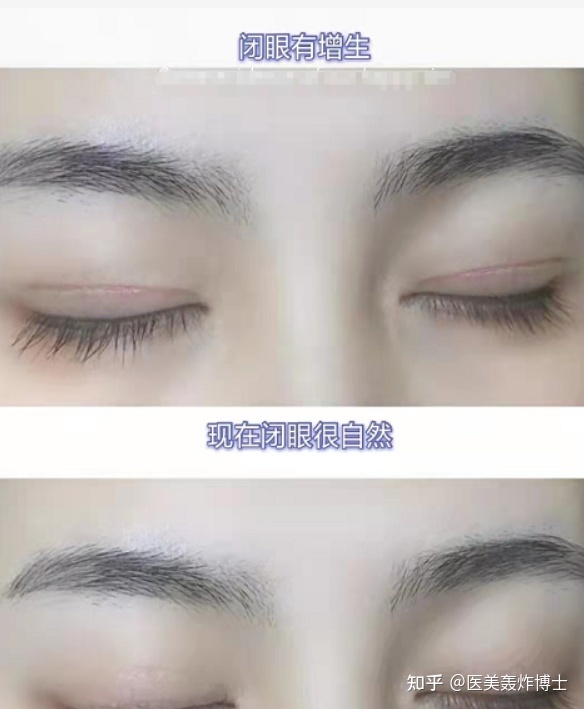 埋线好还是割好