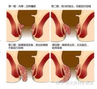 内痔二期怎么治疗