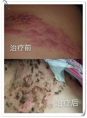 腰部疱疹怎么治疗