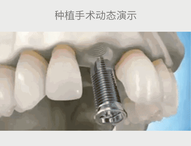 牙齿掉了用活动义齿好吗