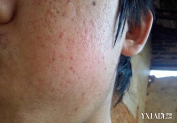 痘好了变成白色痘印