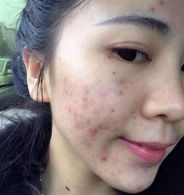 痘痘老是不好_好烦