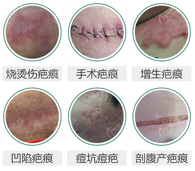 重庆去疤痕