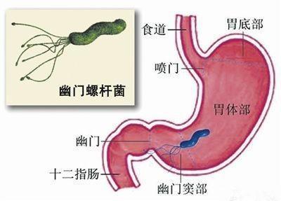 胃螺杆菌怎么治疗