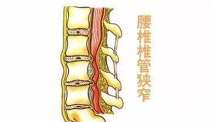 腰椎狭窄怎么治疗效果最好