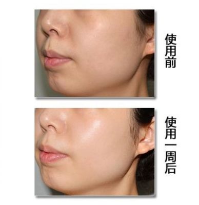 痘痘肌要补水还是保湿