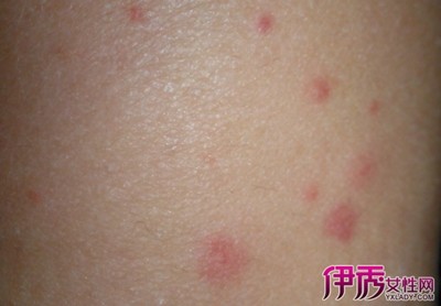身体上红色痘痘痒
