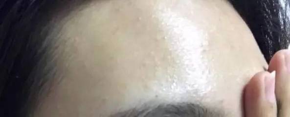 皮肤干会长痘痘