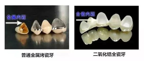 补一颗二氧化锆的牙多少钱