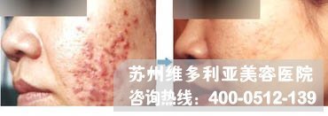 背部 激光治疗 痘痘