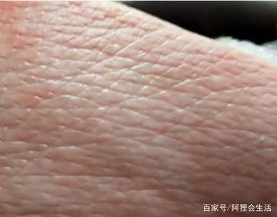 手的毛孔粗大怎么办